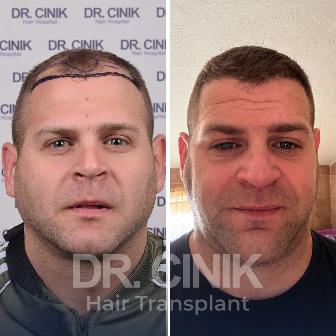 Hair Transplant