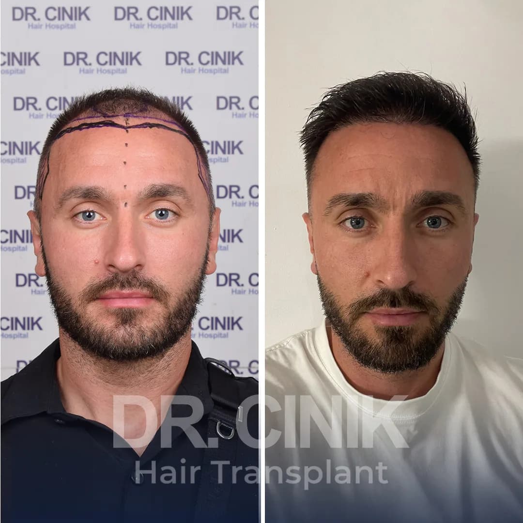 Hair Transplant