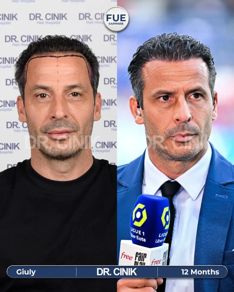 Ludovic Giuly's hair transplant before after