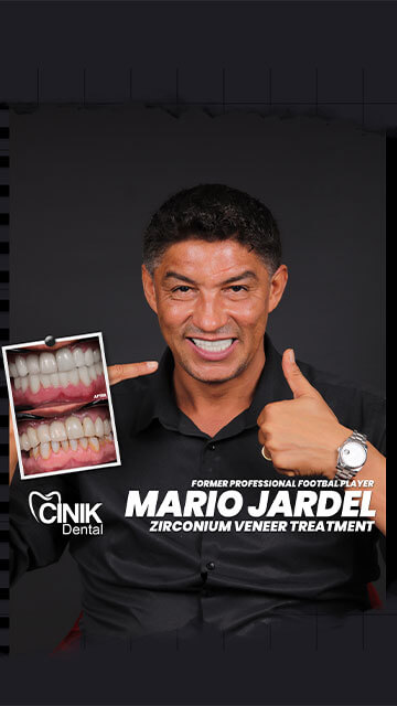 Mário Jarde zirconium veneers treatment
