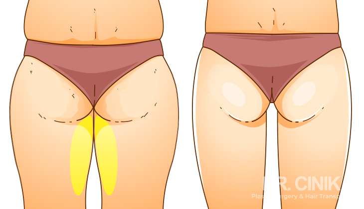 An infographic the showcases the difference between inner thigh lift and other types of thigh lifts