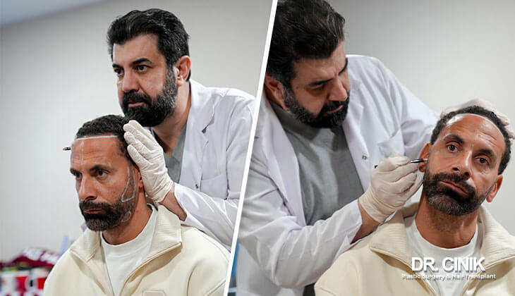 زراعة الشعر بالاقتطاف fue في تركيا
