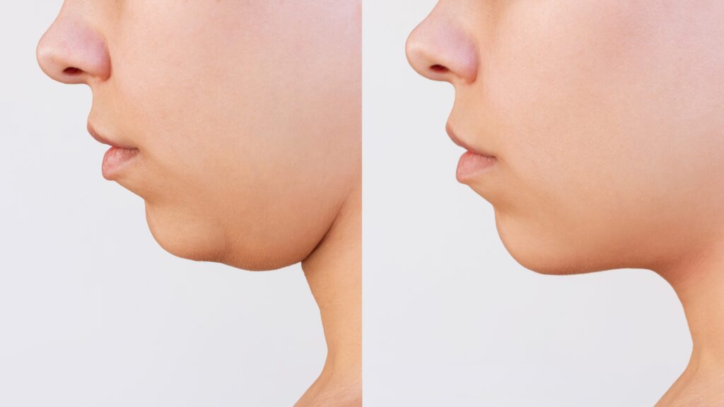 before after chin implant