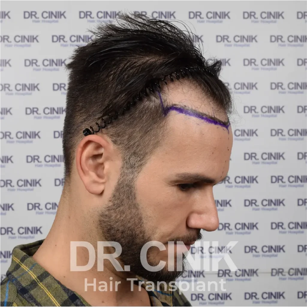 hair transplant before At dr cinik from side of MATTEO DIAMENTE