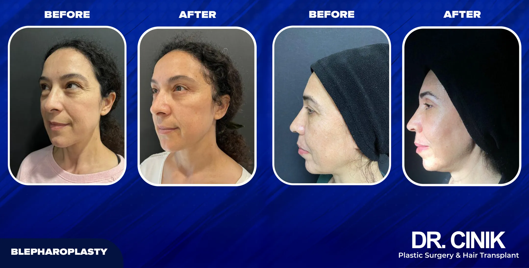 Blepharoplasty Results at Dr. Cinik Hospital 