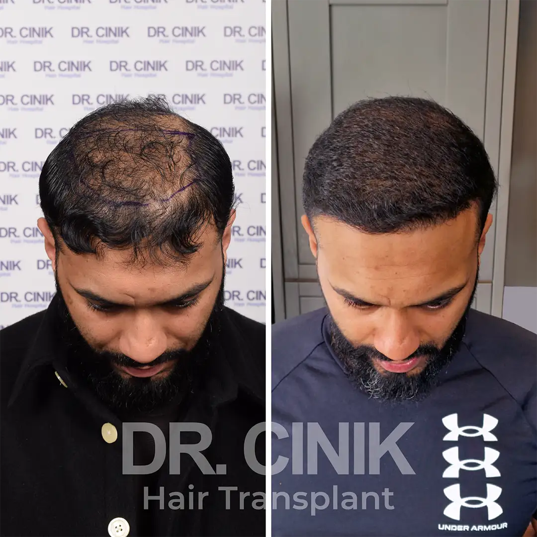 Crown area-hair transplant-before after