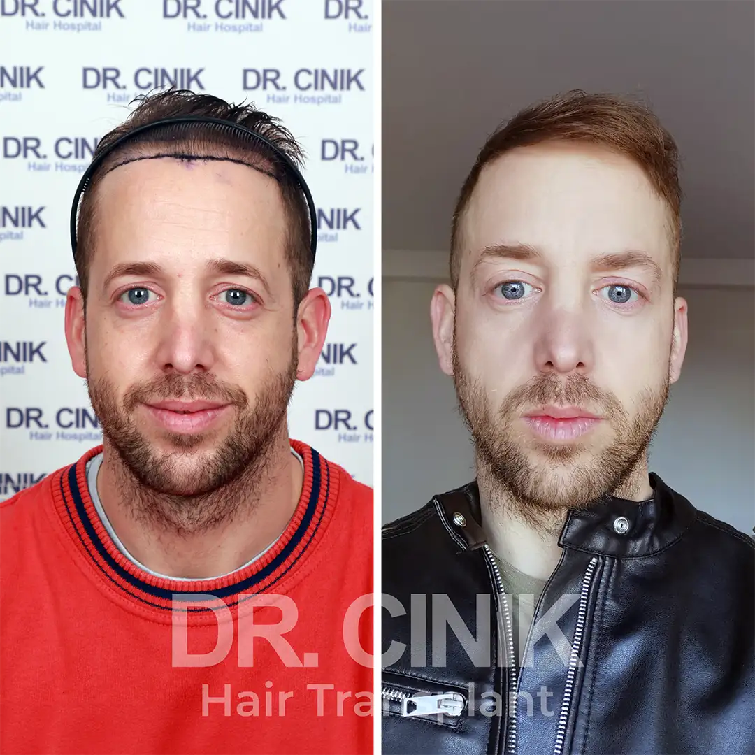 Before and after results of a hair transplant at DR cinik clinic