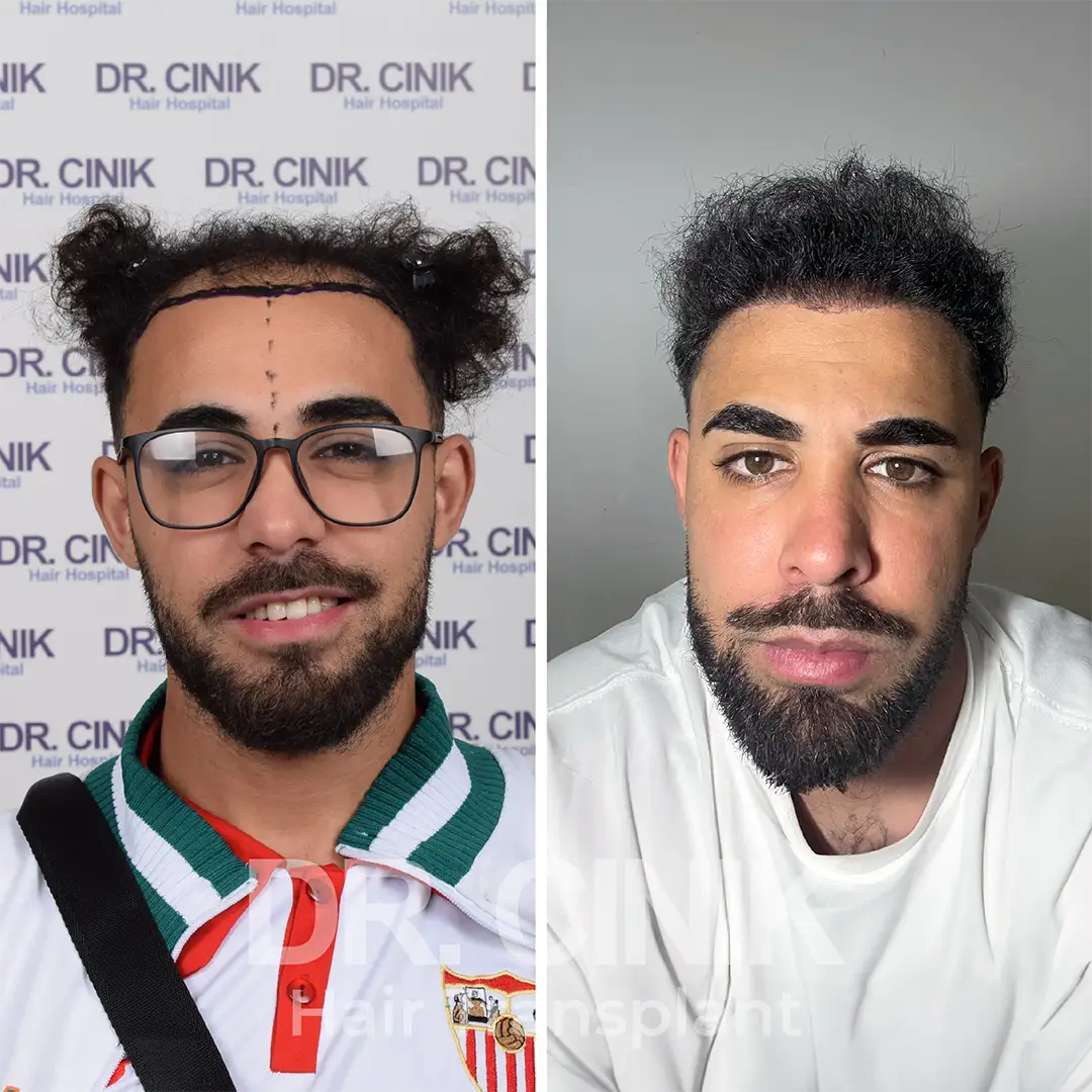 before after results Hair transplant at DR CINIK clinic