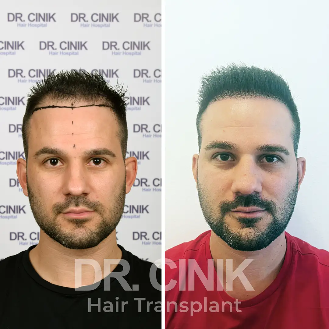 before after results Hair transplant at DR CINIK hospital