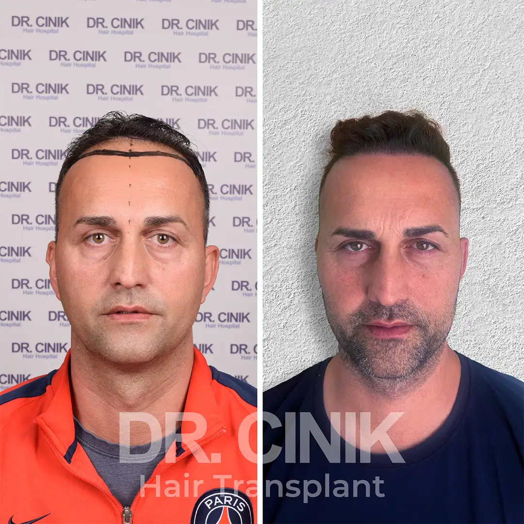 Hair transplant before after results at DR CINIK hospital-2