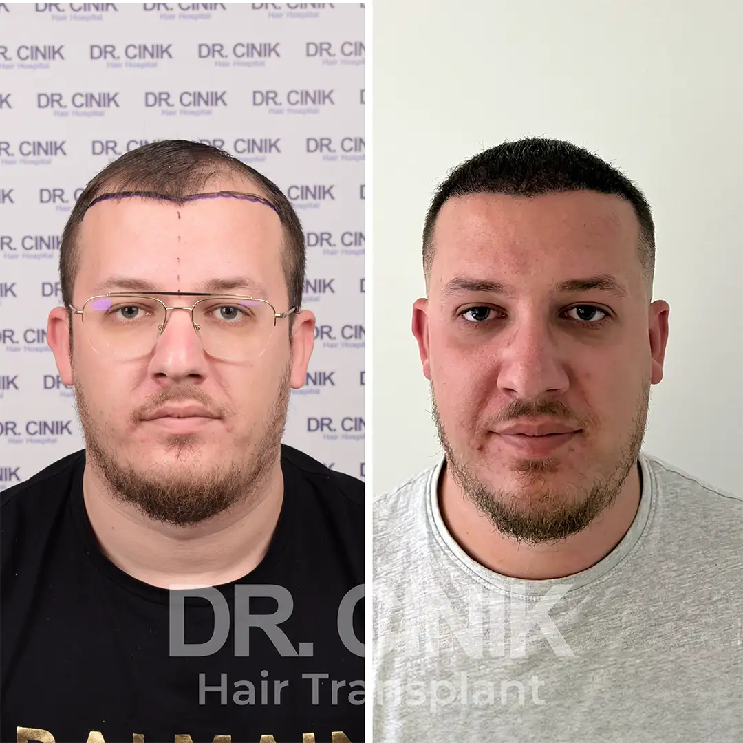 Hair transplant before after results at DR CINIK hospital