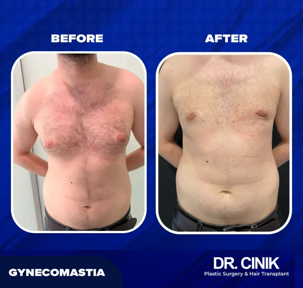 Gynecomastia before after at Dr. cinik Hospital