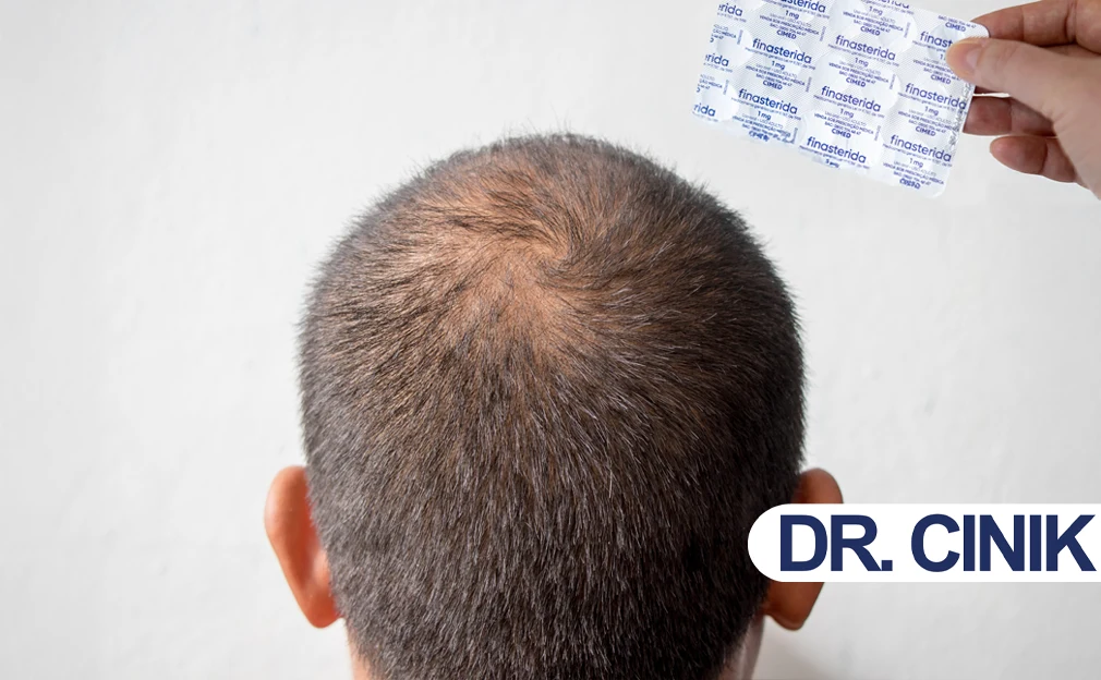 Finasteride’s Side Effects: Between Truths and Myths