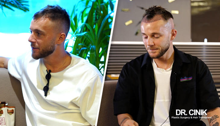 Alexandru Maxim during his hair transplant at dr cinik