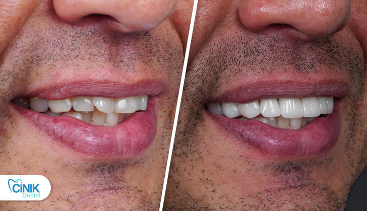 David Trézéguet before after photos