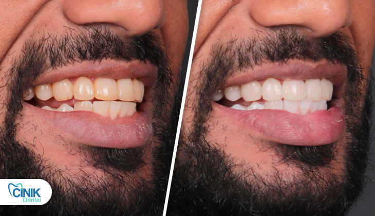 João Pedro before and after results