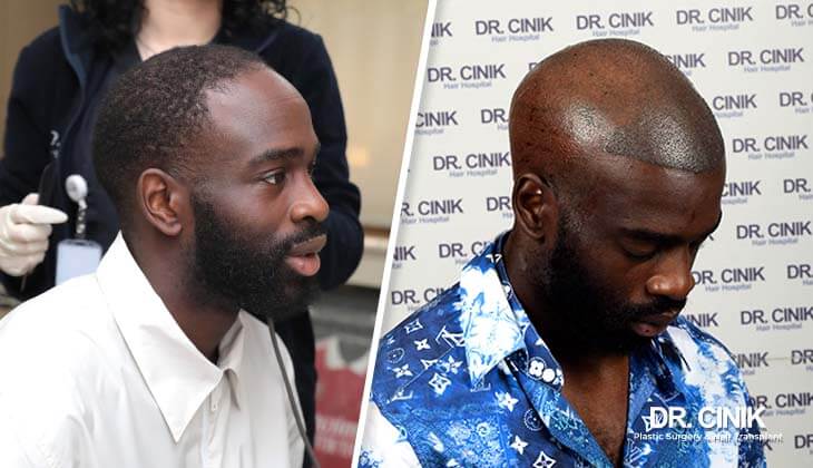 Jonathan Ikoné during hair transplant