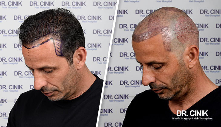 Ludovic Giuly right after his hair transplant surgery
