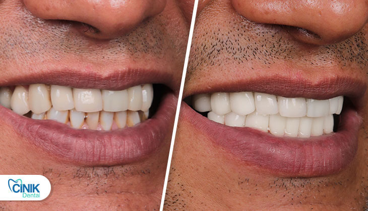Mario Jardel before After
