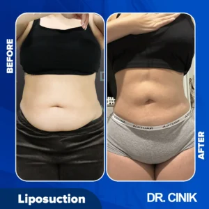 Liposuction for women in Turkey results