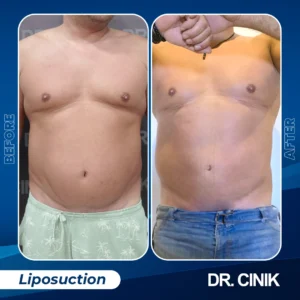 Liposuction for men in Turkey results before after