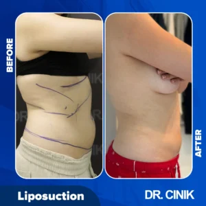 Liposuction in Turkey before after