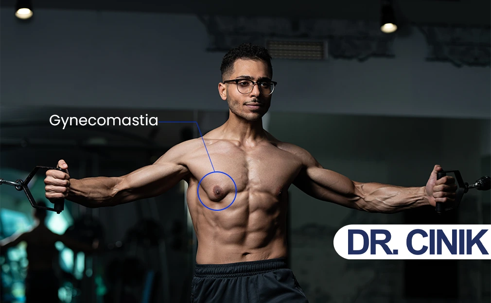 gynecomastia for bodybuilders