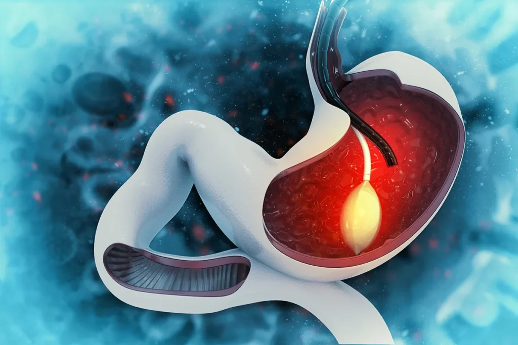 Gastric Balloon Surgery in Turkey