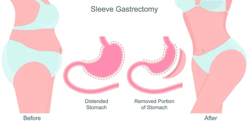 gastric sleeve surgery