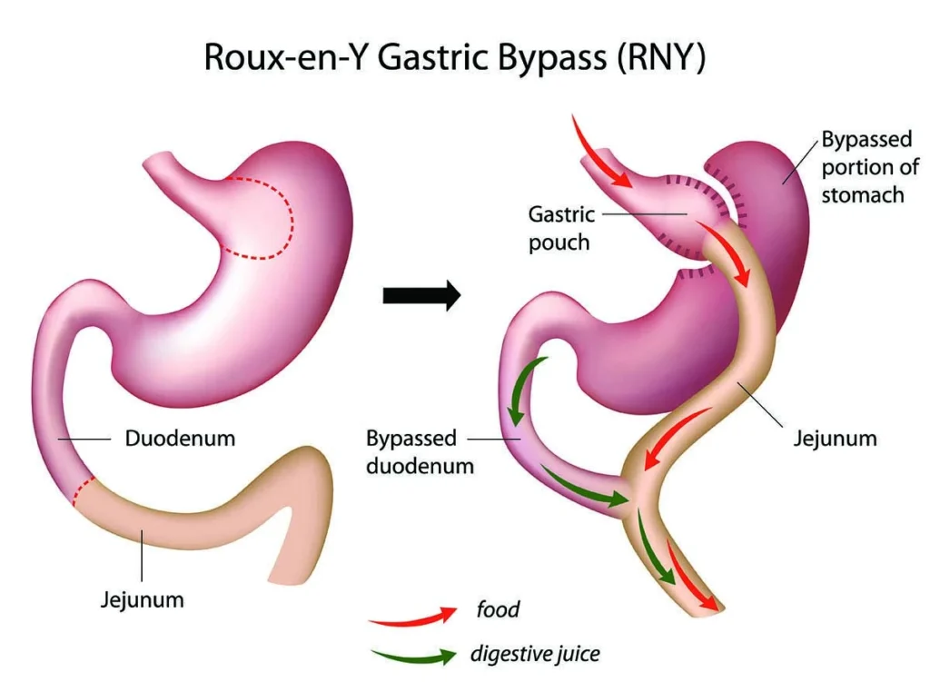 Gastric bypass surgery in Turkey