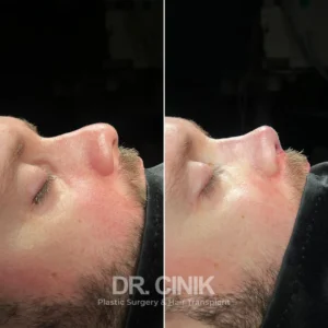 Rhinoplasty in Turkey results before after
