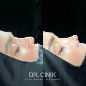 Rhinoplasty in Turkey