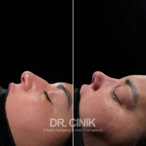 Rhinoplasty in Turkey before after