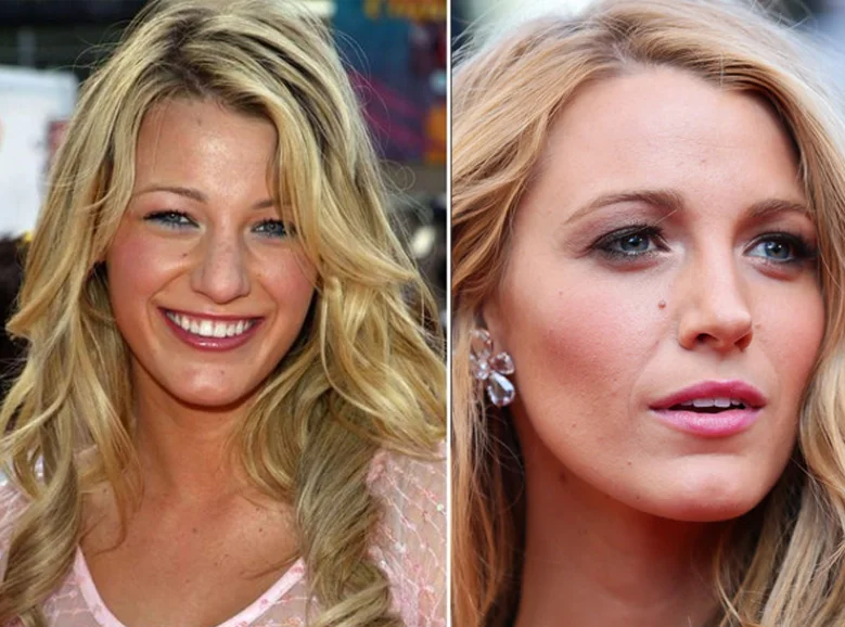 celebrities nose job