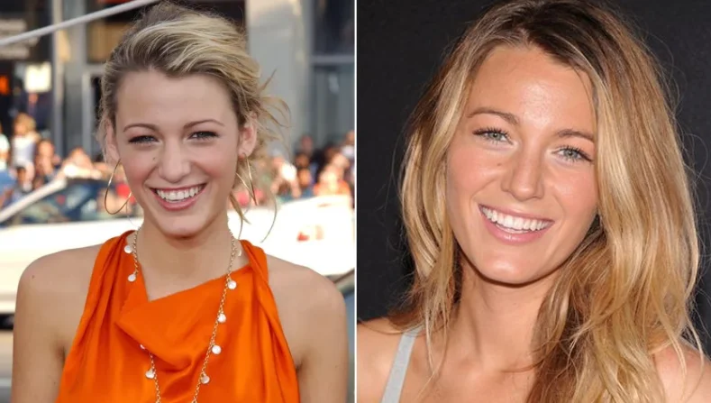 nose job blake lively before after
