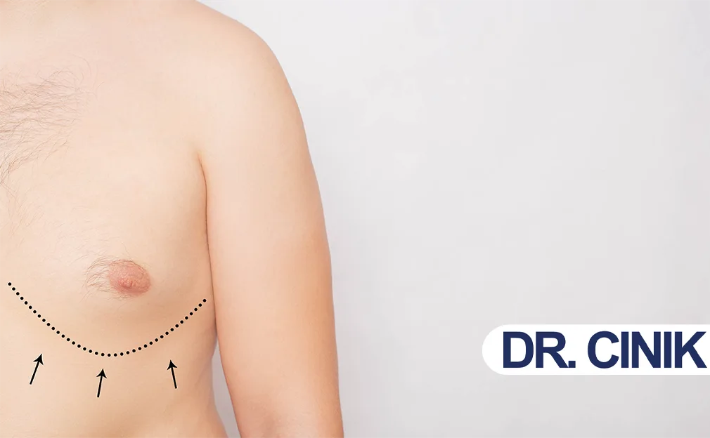 Gynecomastia in Turkey