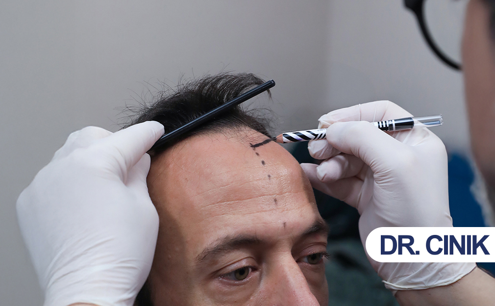 Should I Consider a Hair Transplant?