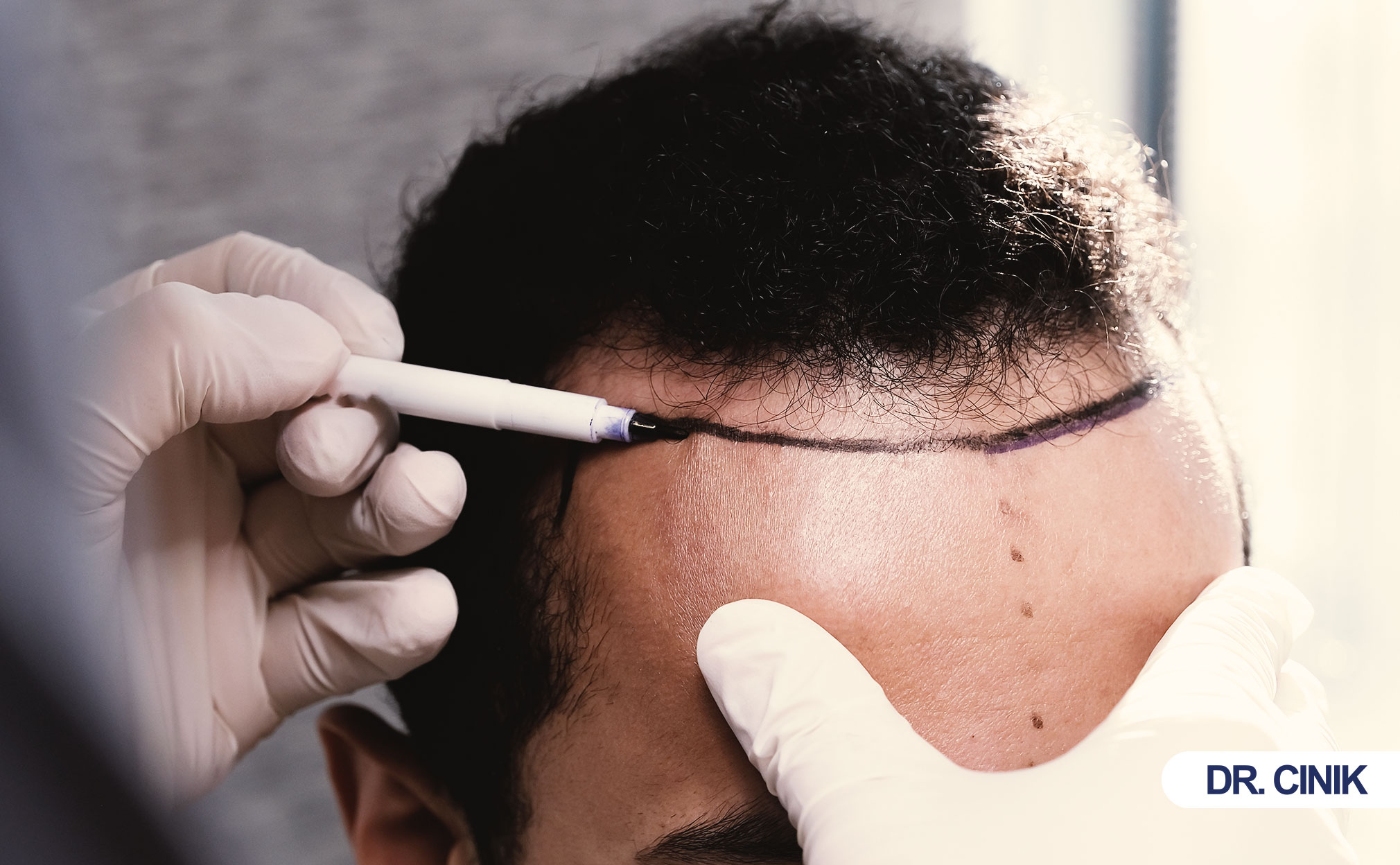 hair transplant