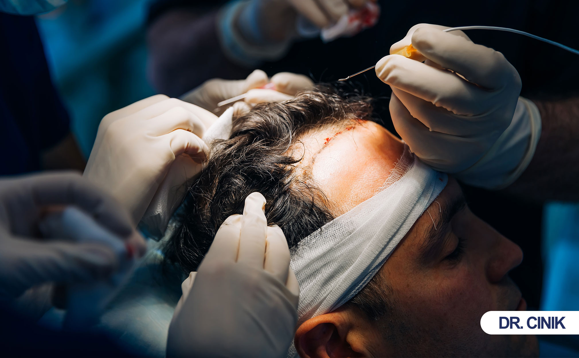 hair transplant