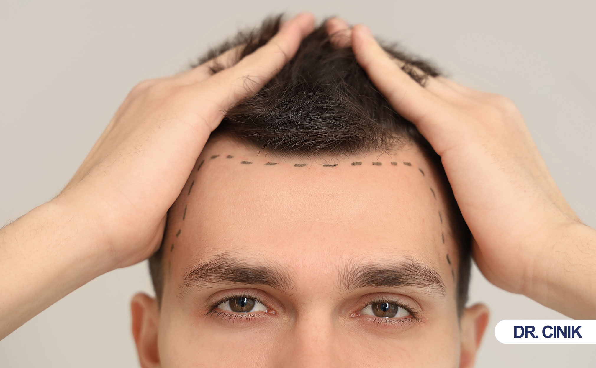 hair transplant