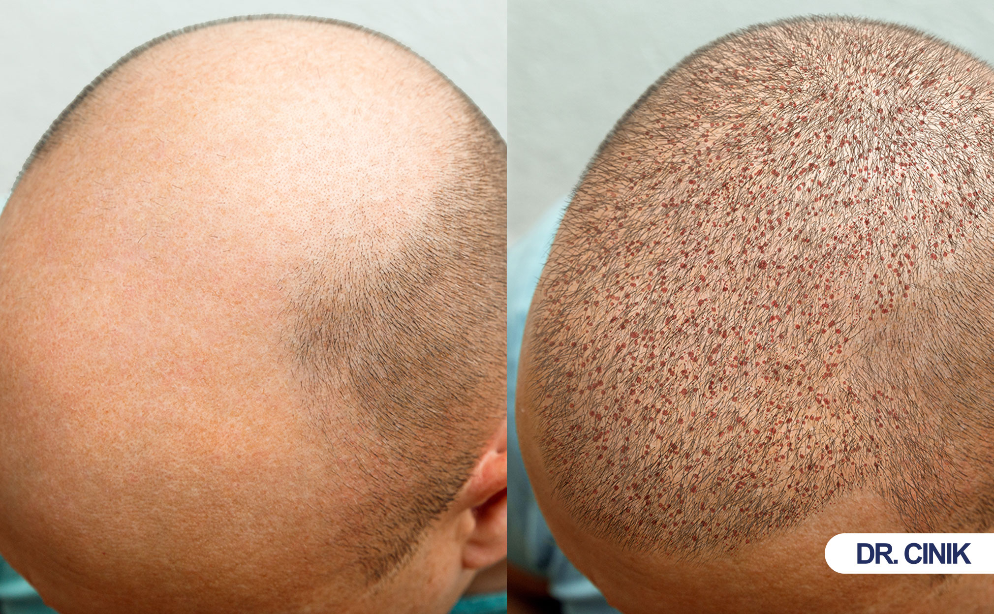 hair transplant