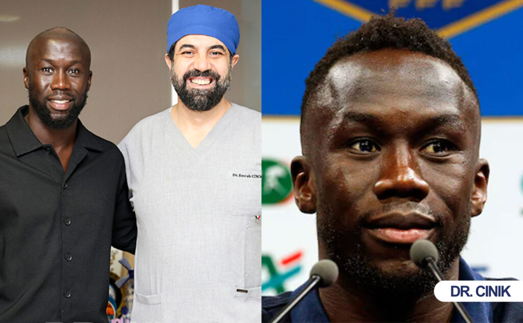 sagna hair transplant