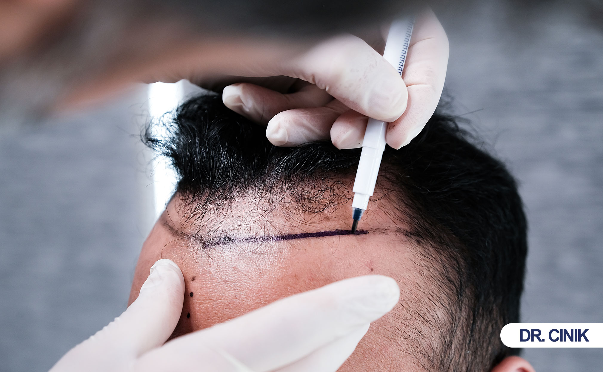 manuel-fue-hair-transplant