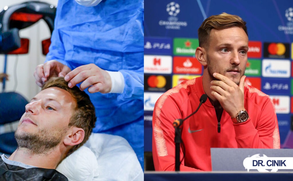 ivan rakitic hair transplant