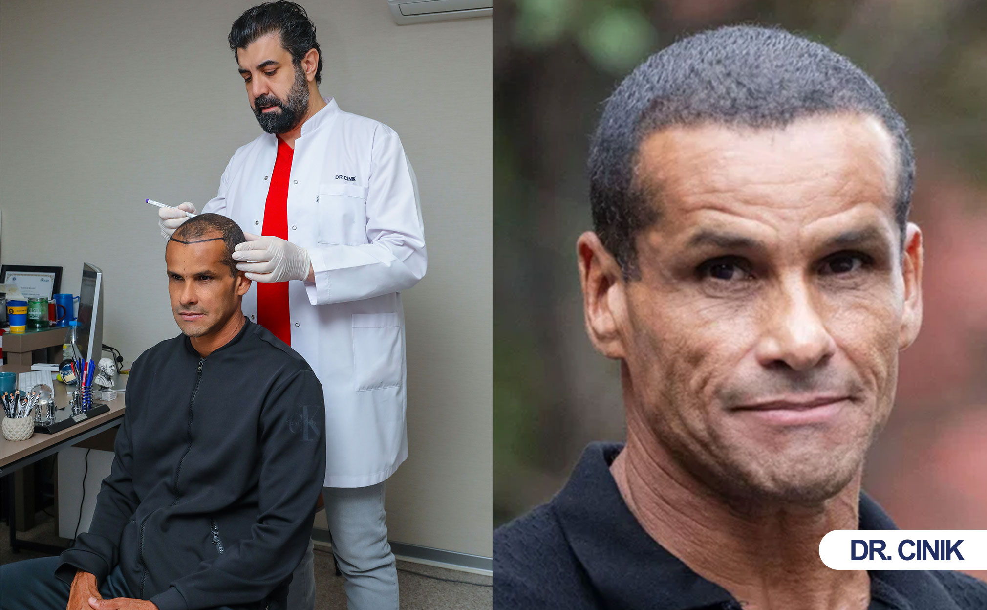 rivaldo hair transplant