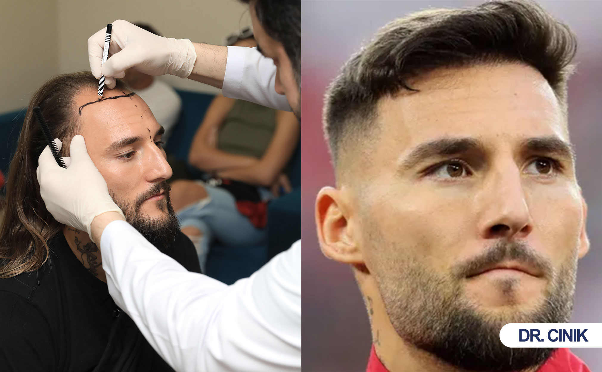 gudelj hair transplant