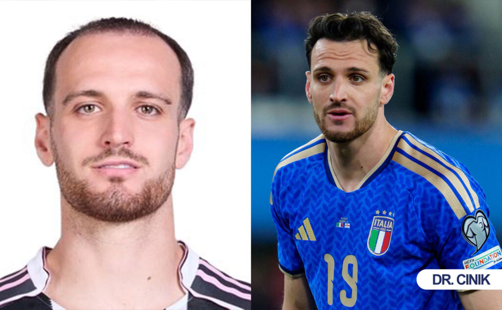 gatti hair transplant