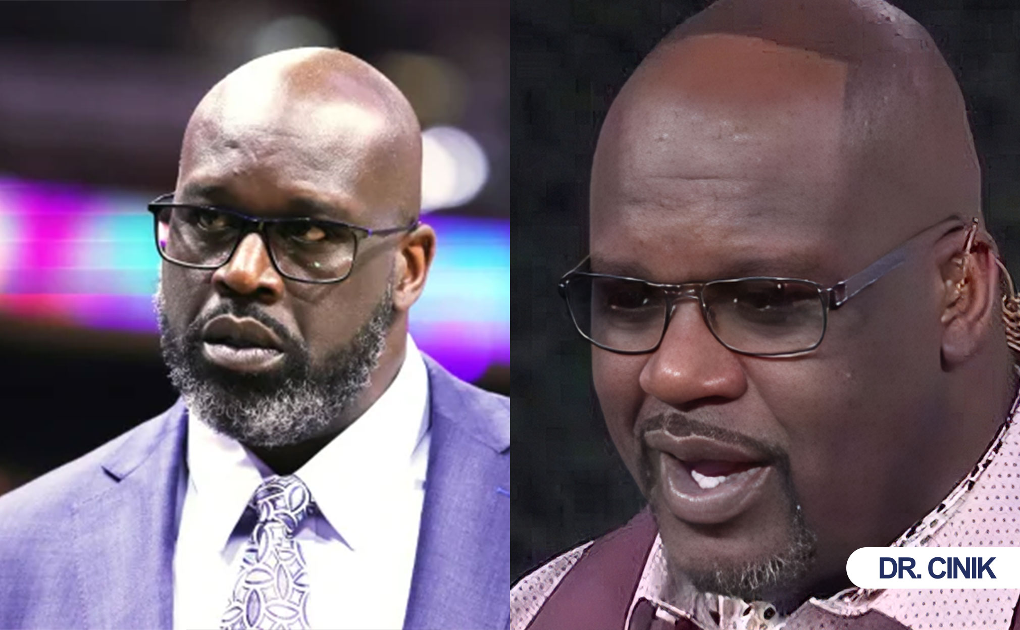 shaq o'neal hair transplant