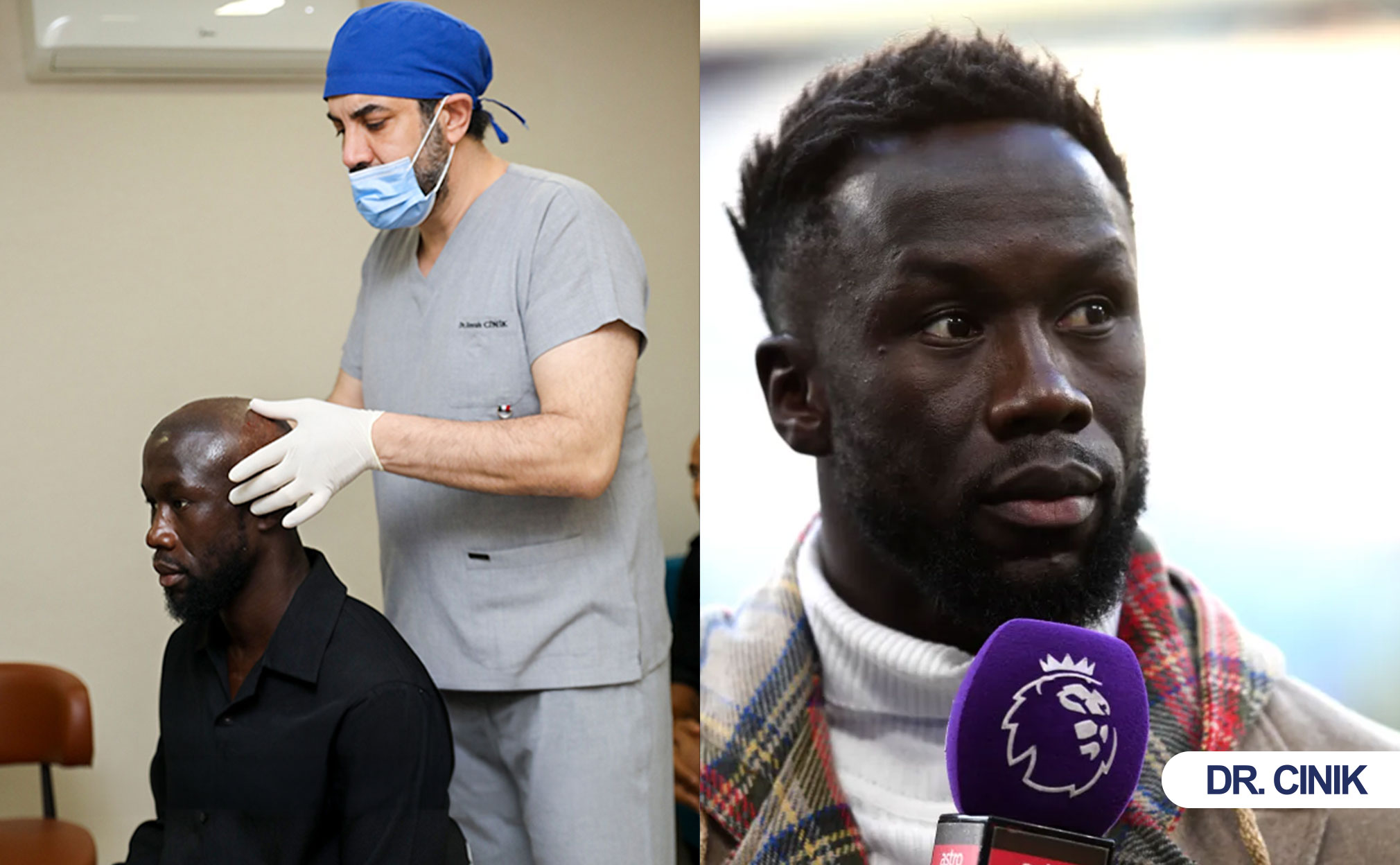 sagna hair transplant