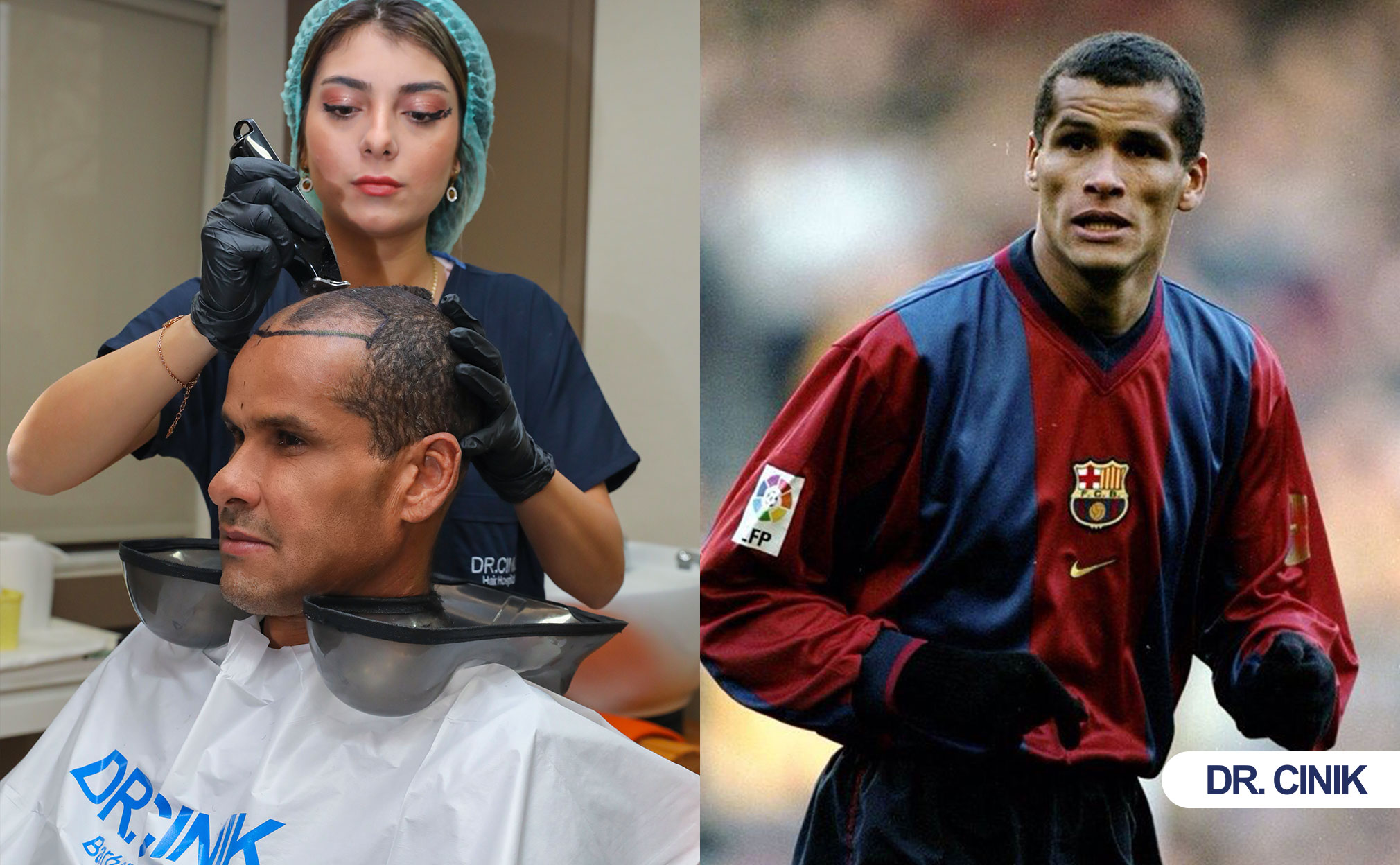 rivaldo hair transplant